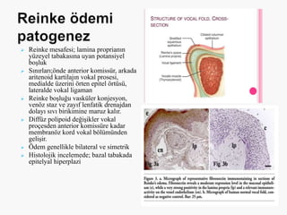  Reinke mesafesi; lamina proprianın
yüzeyel tabakasına uyan potansiyel
boşluk
 Sınırları;önde anterior komissür, arkada
aritenoid kartilajın vokal prosesi,
medialde üzerini örten epitel örtüsü,
lateralde vokal ligaman
 Reinke boşluğu vasküler konjesyon,
venöz staz ve zayıf lenfatik drenajdan
dolayı sıvı birikimine maruz kalır.
 Diffüz polipoid değişikler vokal
proçesden anterior komissüre kadar
membranöz kord vokal bölümünden
gelişir.
 Ödem genellikle bilateral ve simetrik
 Histolojik incelemede; bazal tabakada
epitelyal hiperplazi
 