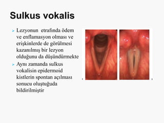  Lezyonun etrafında ödem
ve enflamasyon olması ve
erişkinlerde de görülmesi
kazanılmış bir lezyon
olduğunu da düşündürmekte
 Aynı zamanda sulkus
vokalisin epidermoid
kistlerin spontan açılması
sonucu oluştuğuda
bildirilmiştir
 