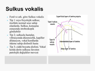  Ford ve ark. göre Sulkus vokalis
 Tip 1 veya fizyolojik sulkus;
özelikle normal sese sahip
olanlarda. Sulkus, konuşma
esnasında stroboskopik
görülebilir
 Tip 2; sulkuslu hastalar,
vibrasyonda düzensizlik, kapiller
dilatasyon, vokal kordlarda
ödeme sahip disfonili hasta
 Tip 3; ciddi boyutta disfoni. Vokal
korda derin sulkusa ilaveten
patolojik değişikler mevcut
 