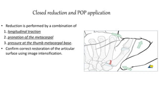 Closed reduction and POP application
• Reduction is performed by a combination of
1. longitudinal traction
2. pronation of the metacarpal
3. pressure at the thumb metacarpal base.
• Confirm correct restoration of the articular
surface using image intensification.
 