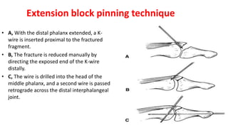 Extension block pinning technique
• A, With the distal phalanx extended, a K-
wire is inserted proximal to the fractured
fragment.
• B, The fracture is reduced manually by
directing the exposed end of the K-wire
distally.
• C, The wire is drilled into the head of the
middle phalanx, and a second wire is passed
retrograde across the distal interphalangeal
joint.
 