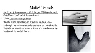 Mallet Thumb
• Avulsion of the extensor pollicis longus (EPL) tendon at its
distal insertion (mallet thumb) is rare.
• A/K/A Goose neck deformity .
• Usually a late complication of colles’ fracture , RA .
• Although the recommended treatment for closed mallet
finger is conservative, some authors proposed operative
treatment for mallet thumb.
 