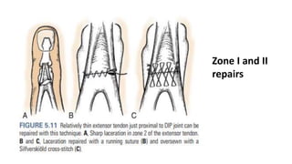 Zone I and II
repairs
 