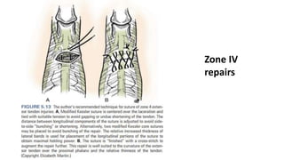 Zone IV
repairs
 