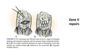 Zone V
repairs
 