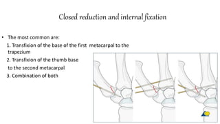 Closed reduction and internal fixation
• The most common are:
1. Transfixion of the base of the first metacarpal to the
trapezium
2. Transfixion of the thumb base
to the second metacarpal
3. Combination of both
 