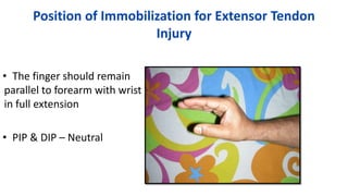 Position of Immobilization for Extensor Tendon
Injury
• The finger should remain
parallel to forearm with wrist
in full extension
• PIP & DIP – Neutral
 