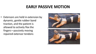 EARLY PASSIVE MOTION
• Extensors are held in extension by
dynamic, gentle rubber band
traction, and the patient is
allowed to actively flex the
fingers—passively moving
repaired extensor tendons
 