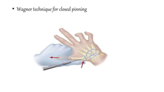 • Wagner technique for closed pinning
 