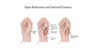 Open Reduction and Internal Fixation
 