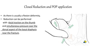 Closed Reduction and POP application
• As there is usually a flexion deformity,
• Reduction can be performed
with -Axial traction on the thumb
and simultaneous pressure over the
dorsal aspect of the basal diaphysis
near the fracture.
 