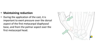 • Maintaining reduction
• During the application of the cast, it is
important to exert pressure over the dorsal
aspect of the first metacarpal diaphyseal
base, and from the palmar aspect over the
first metacarpal head.
 