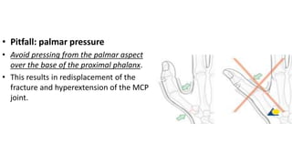 • Pitfall: palmar pressure
• Avoid pressing from the palmar aspect
over the base of the proximal phalanx.
• This results in redisplacement of the
fracture and hyperextension of the MCP
joint.
 
