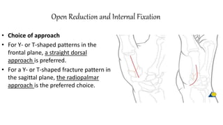 Open Reduction and Internal Fixation
• Choice of approach
• For Y- or T-shaped patterns in the
frontal plane, a straight dorsal
approach is preferred.
• For a Y- or T-shaped fracture pattern in
the sagittal plane, the radiopalmar
approach is the preferred choice.
 