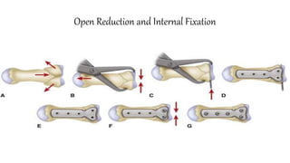 Open Reduction and Internal Fixation
 