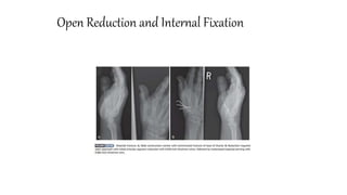 Open Reduction and Internal Fixation
 
