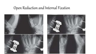 Open Reduction and Internal Fixation
 