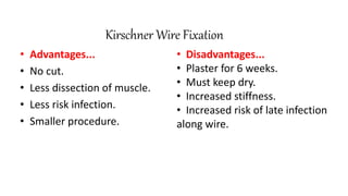 Kirschner Wire Fixation
• Advantages...
• No cut.
• Less dissection of muscle.
• Less risk infection.
• Smaller procedure.
• Disadvantages...
• Plaster for 6 weeks.
• Must keep dry.
• Increased stiffness.
• Increased risk of late infection
along wire.
 