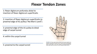 Flexor Tendon Zones
1: flexor digitorum profundus distal to
insertion of flexor digitorum superficialis
2: insertion of flexor digitorum superficialis to
proximal edge of A1 pulley (“No Man’s Land”)
3: proximal edge of the A1 pulley to distal
edge of carpal tunnel
4: within the carpal tunnel
5: proximal to the carpal tunnel
 