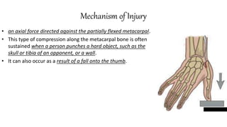 Mechanism of Injury
• an axial force directed against the partially flexed metacarpal.
• This type of compression along the metacarpal bone is often
sustained when a person punches a hard object, such as the
skull or tibia of an opponent, or a wall.
• It can also occur as a result of a fall onto the thumb.
 