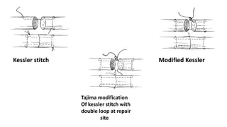 Kessler stitch Modified Kessler
Tajima modification
Of kessler stitch with
double loop at repair
site
 