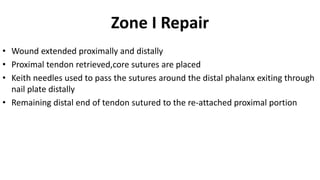 Zone I Repair
• Wound extended proximally and distally
• Proximal tendon retrieved,core sutures are placed
• Keith needles used to pass the sutures around the distal phalanx exiting through
nail plate distally
• Remaining distal end of tendon sutured to the re-attached proximal portion
 