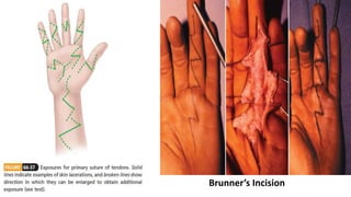 Brunner’s Incision
 