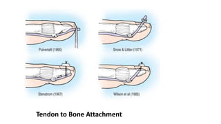Tendon to Bone Attachment
 