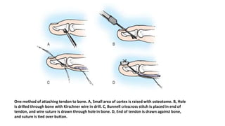 One method of attaching tendon to bone. A, Small area of cortex is raised with osteotome. B, Hole
is drilled through bone with Kirschner wire in drill. C, Bunnell crisscross stitch is placed in end of
tendon, and wire suture is drawn through hole in bone. D, End of tendon is drawn against bone,
and suture is tied over button.
 