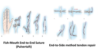 Fish-Mouth End-to-End Suture
(Pulvertaft) End-to-Side method tendon repair
 