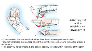 • Combines dorsal extension block with rubber-band traction proximal to wrist
• Originally, included a nylon loop placed through the nail, and around the nail is placed a
rubber band
• This passively flexes fingers, & the patient actively extends within the limits of the splint
Active range of
motion
rehabilitation
Kleinert !!
 