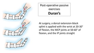 Post-operative passive
exercises
Duran’s
At surgery, a dorsal extension-block
splint is applied with the wrist at 20-30°
of flexion, the MCP joints at 50-60° of
flexion, and the IP joints straight
 