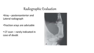 Radiographic Evaluation
•Xray – posteroanterior and
Lateral radiograph
•Traction xrays are advisable
• CT scan – rarely indicated in
case of doubt
 