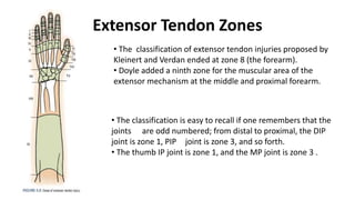 Extensor Tendon Zones
• The classification of extensor tendon injuries proposed by
Kleinert and Verdan ended at zone 8 (the forearm).
• Doyle added a ninth zone for the muscular area of the
extensor mechanism at the middle and proximal forearm.
• The classification is easy to recall if one remembers that the
joints are odd numbered; from distal to proximal, the DIP
joint is zone 1, PIP joint is zone 3, and so forth.
• The thumb IP joint is zone 1, and the MP joint is zone 3 .
 