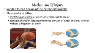 Mechanism Of Injury
• Sudden forced flexion of the extended fingertip.
• This results in either:
• stretching or tearing of extensor tendon substance or
• avulsion of tendon insertion from the dorsum of distal phalanx, with or
without a fragment of bone.
 