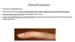 Clinical Evaluation
• Relatively straightforward.
• Patients present with pain,swelling, deformity, and/or difficulty using the affected finger.
• Extensor lag at the DIP joint immediately after injury.
• Concurrent hyperextension of the PIP joint (ie, swan neck posture) may be noted with active
finger extension.
 
