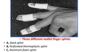 • Three different mallet finger splints
• A, Stack splint
• B, Perforated thermoplastic splint
• C, Aluminum foam splint
 