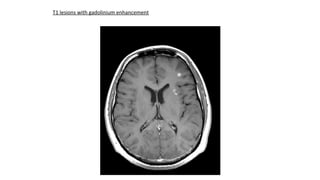 T1 lesions with gadolinium enhancement
 