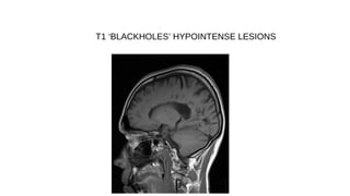 T1 ‘BLACKHOLES’ HYPOINTENSE LESIONS
 