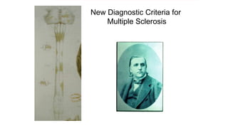 New Diagnostic Criteria for
Multiple Sclerosis
 