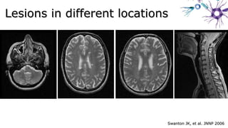 Swanton JK, et al. JNNP 2006Swanton JK, et al. JNNP 2006
Lesions in different locationsLesions in different locations
 