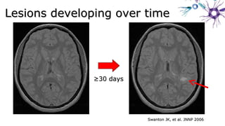Swanton JK, et al. JNNP 2006Swanton JK, et al. JNNP 2006
Lesions developing over timeLesions developing over time
≥≥30 days30 days
 