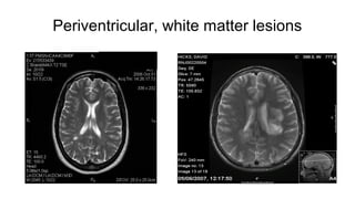 Periventricular, white matter lesions
 