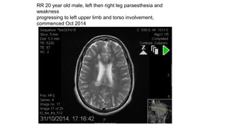 RR 20 year old male, left then right leg paraesthesia and
weakness
progressing to left upper limb and torso involvement,
commenced Oct 2014
 