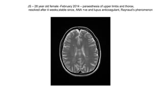 JS – 28 year old female -February 2014 – paraesthesia of upper limbs and thorax,
resolved after 4 weeks,stable since, ANA +ve and lupus anticoagulant, Raynaud’s phenomenon
 