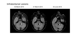 03 March 2014 31 March 2014 03 June 2014
Infratentorial Lesions
 