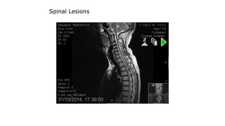 Spinal Lesions
 