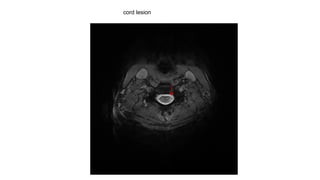 cord lesion
 