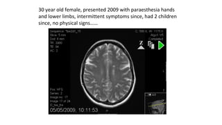 30 year old female, presented 2009 with paraesthesia hands
and lower limbs, intermittent symptoms since, had 2 children
since, no physical signs……
 