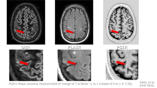 Sethi, et al.Sethi, et al.
JNNP 2012JNNP 2012
DIRDIR FLAIRFLAIR PSIRPSIR
PSIR= Phase sensitive reconstructed IR (range of TPSIR= Phase sensitive reconstructed IR (range of T11w factor -1 to 1 instead of 0 to 1 in Tw factor -1 to 1 instead of 0 to 1 in T11SE)SE)
 